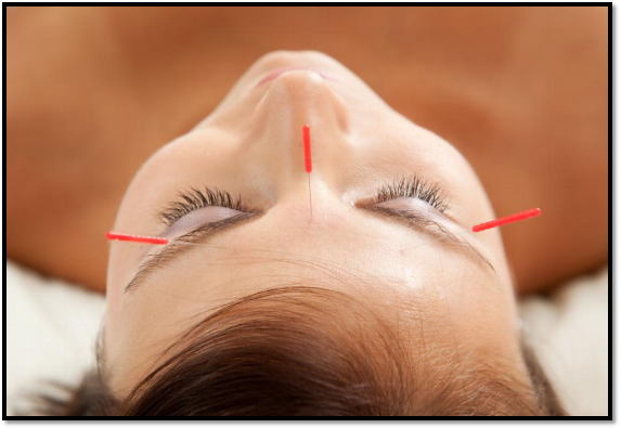Acupuncture and Mental Health—what’s the Connection?