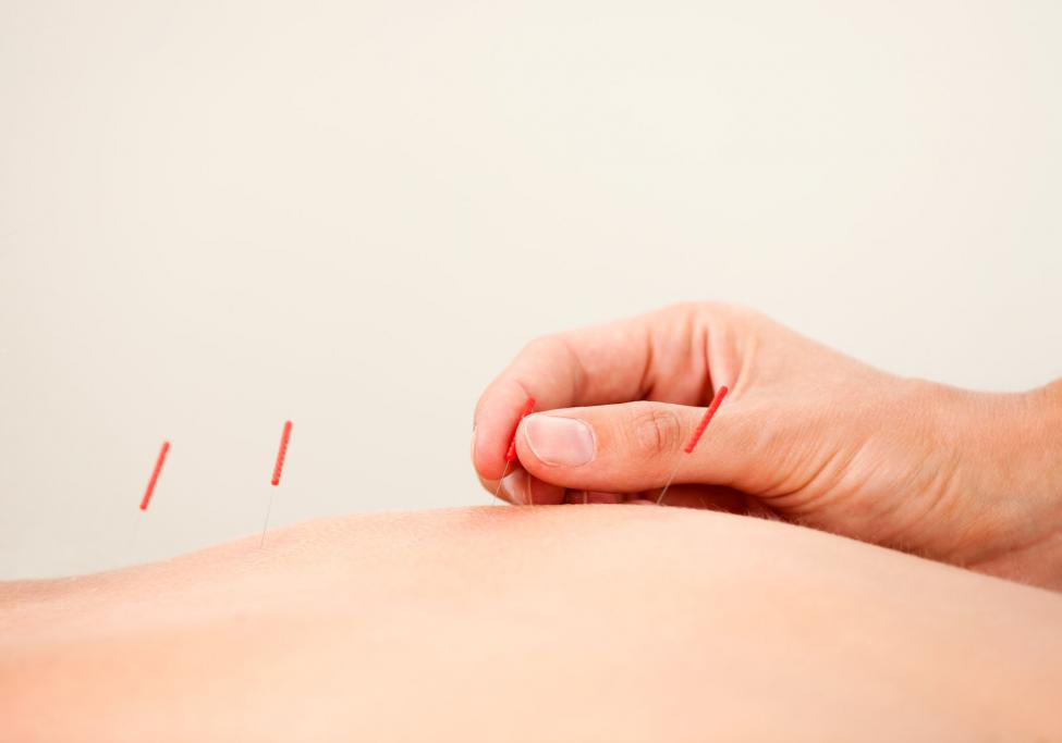 Acupuncture for Back Pain Does it Work 1