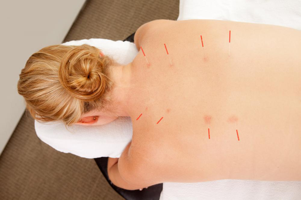 Relaxation Therapy with Acupuncture1